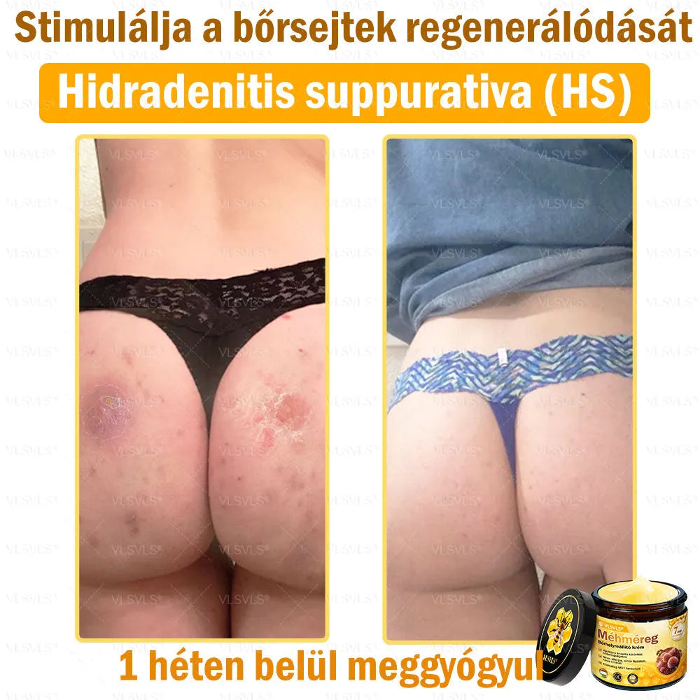 VLSVLS® Méhméreg Bőrhelyreállító Krém (👨‍⚕‍CE jóváhagyott)👍✅
