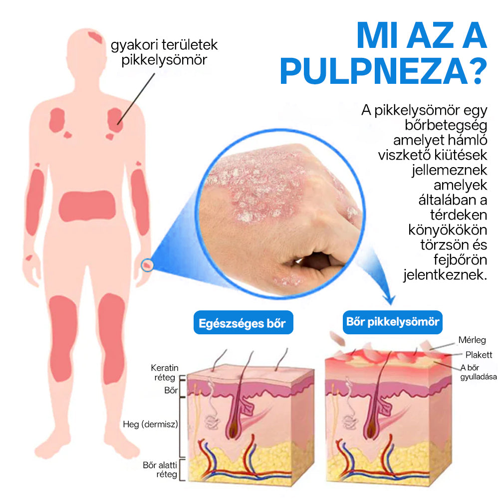 Zvoevo® Magnézium Gyógynövényes Pszoriázis Spray✨