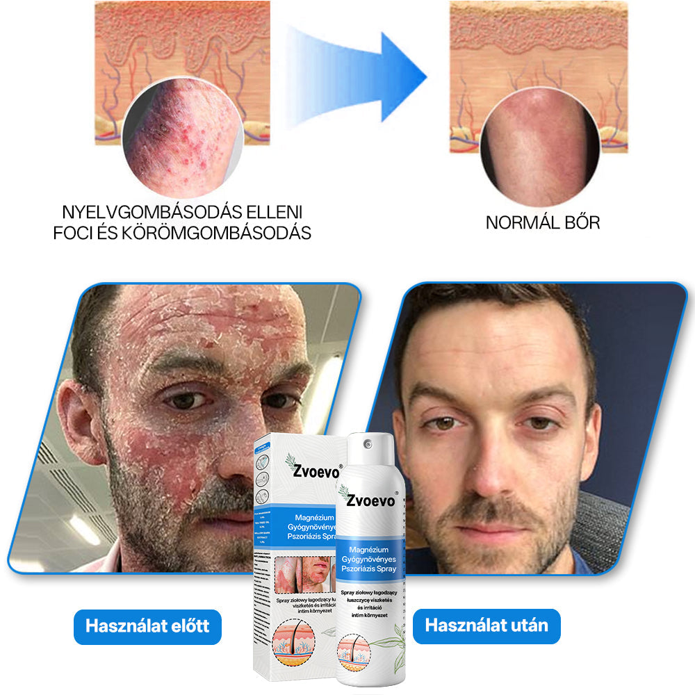 Zvoevo® Magnézium Gyógynövényes Pszoriázis Spray✨