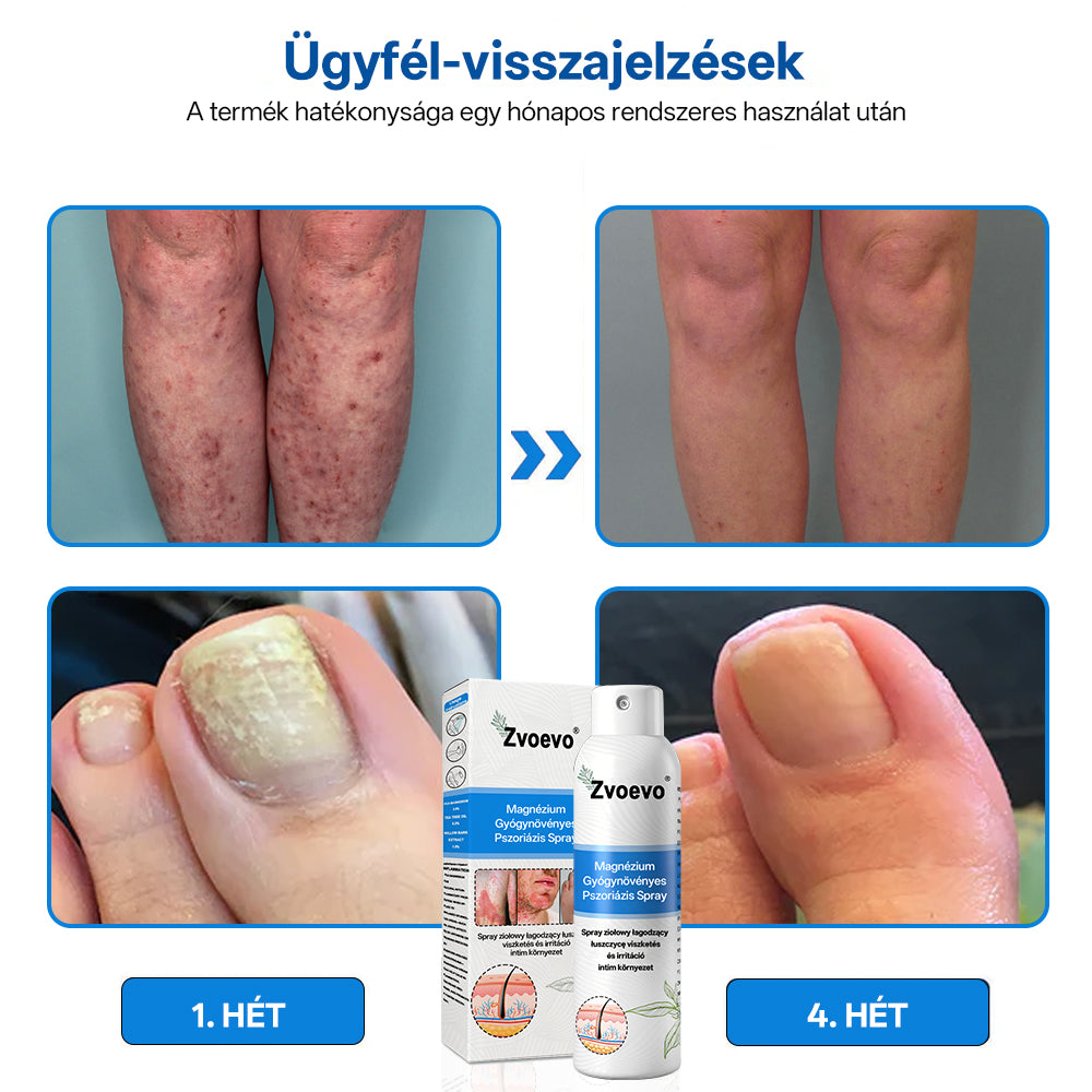 Zvoevo® Magnézium Gyógynövényes Pszoriázis Spray✨