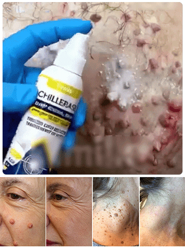 Timilk szemölcs elleni külső ápoló spray