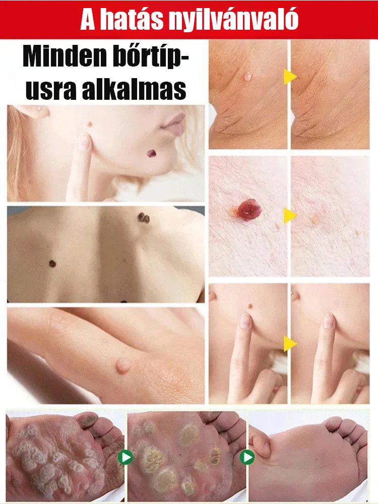 Timilk szemölcs elleni külső ápoló spray