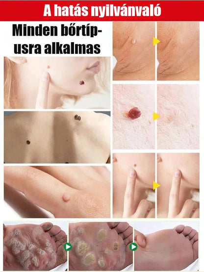 Timilk szemölcs elleni külső ápoló spray