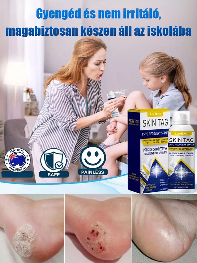 Bőrszemölcs külső ápoló permet Bőrszemölcs külső ápoló permet ！！！Mondj búcsút a szemölcsöknek, légy magabiztos minden pillanatban!