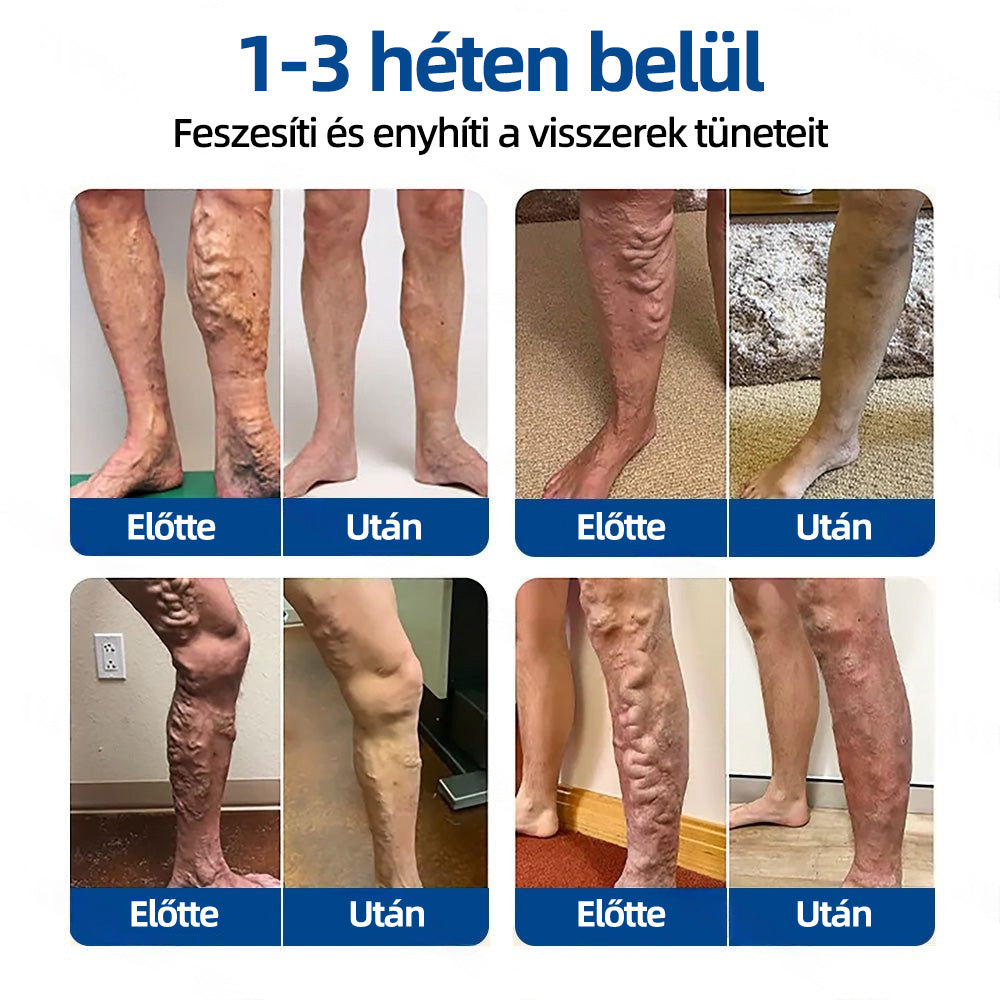 🇭🇺Yutuof® 👩‍⚕️VeinTarget mikrotűs tapasz⚡Azonnali enyhülés hosszú távú eredmények-🔥🔥🔥