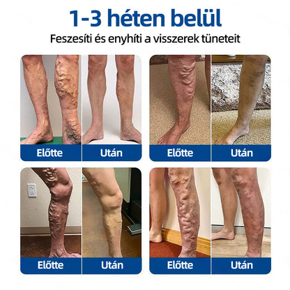 🇭🇺Yutuof® 👩‍⚕️VeinTarget mikrotűs tapasz⚡Azonnali enyhülés hosszú távú eredmények-🔥🔥🔥