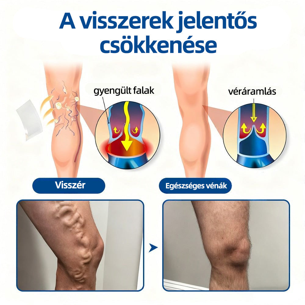 🇭🇺Yutuof® 👩‍⚕️VeinTarget mikrotűs tapasz⚡Azonnali enyhülés hosszú távú eredmények-🔥🔥🔥